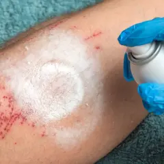 Ręka w niebieskiej rękawiczce aplikuje spray na podrażnioną skórę nogi. Czerwone kropki i biały osad przypominają o trudnych chwilach, jak cytaty o ranieniu bliskich.