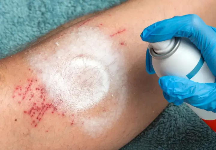 Ręka w niebieskiej rękawiczce aplikuje spray na podrażnioną skórę nogi. Czerwone kropki i biały osad przypominają o trudnych chwilach, jak cytaty o ranieniu bliskich.