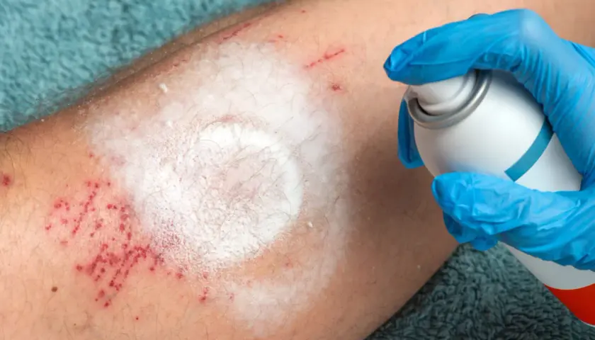 Ręka w niebieskiej rękawiczce aplikuje spray na podrażnioną skórę nogi. Czerwone kropki i biały osad przypominają o trudnych chwilach, jak cytaty o ranieniu bliskich.