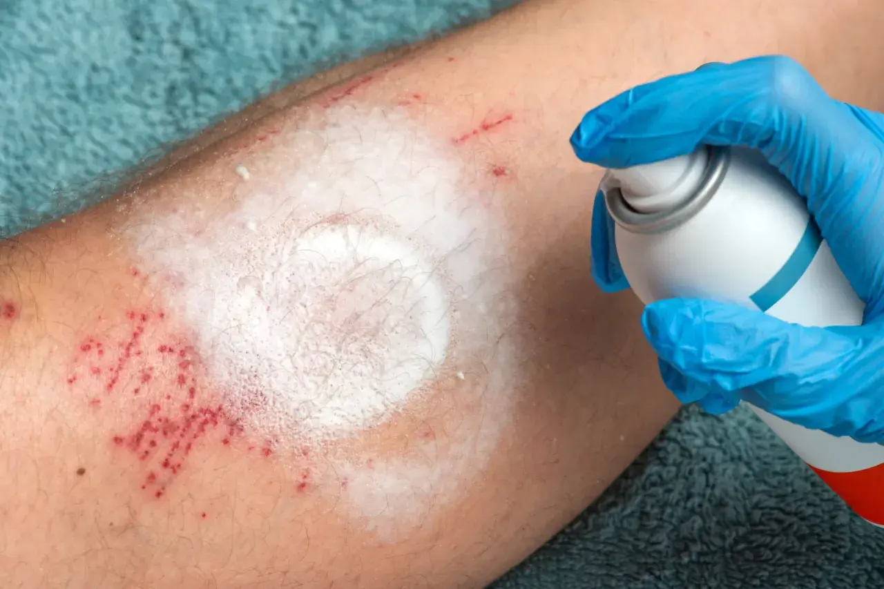 Ręka w niebieskiej rękawiczce aplikuje spray na podrażnioną skórę nogi. Czerwone kropki i biały osad przypominają o trudnych chwilach, jak cytaty o ranieniu bliskich.